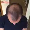 A man's head is shown before and after a hair transplant featuring REDi Rise.