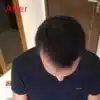 A man's head is shown before and after a revolutionary hair transplant using a hair growth cap.